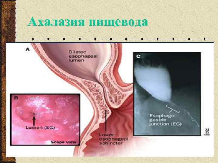 Здоровый пищевод фото