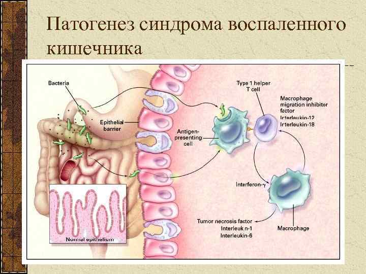 Патогенез синдрома воспаленного кишечника 