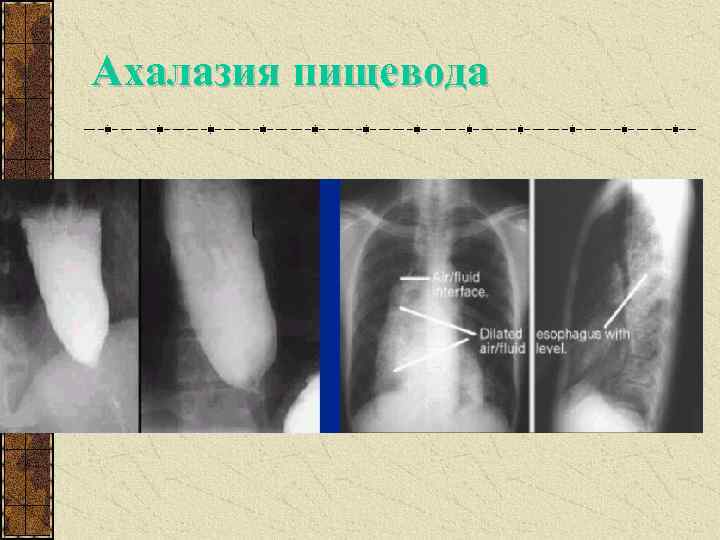 Ахалазия пищевода 