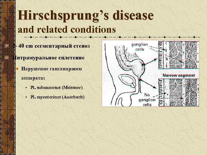 Hirschsprung’s disease and related conditions 2 - 40 cm сегментарный стеноз Интрамуральное сплетение Нарушение