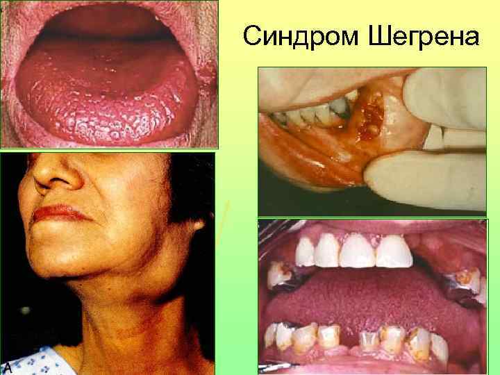 Синдром Шегрена 