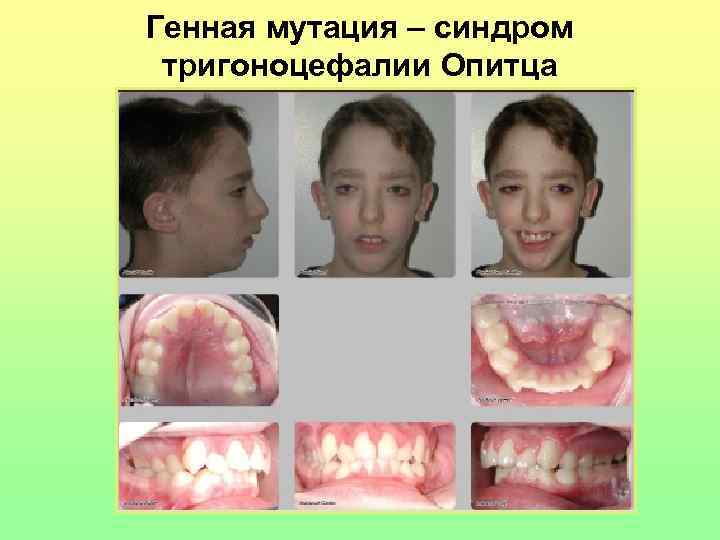 Генная мутация – синдром тригоноцефалии Опитца 