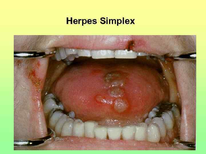 Herpes Simplex 