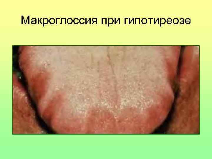 Макроглоссия при гипотиреозе 