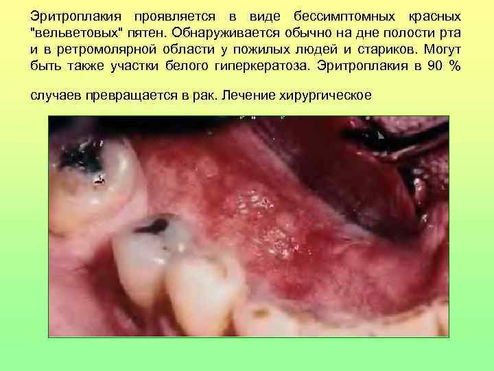 Эритроплакия проявляется в виде бессимптомных красных 