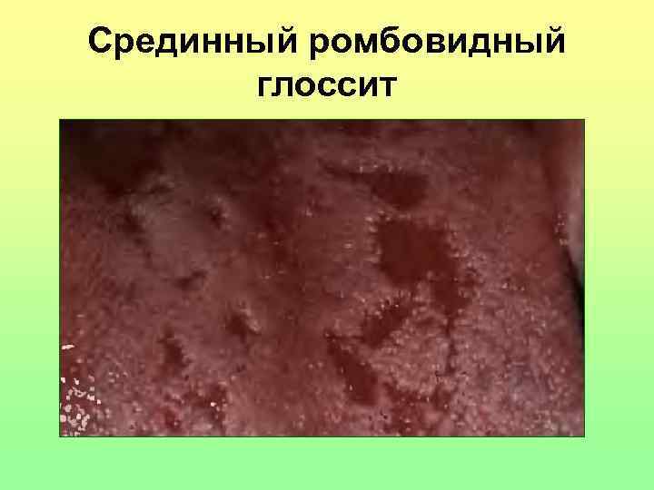 Срединный ромбовидный глоссит 