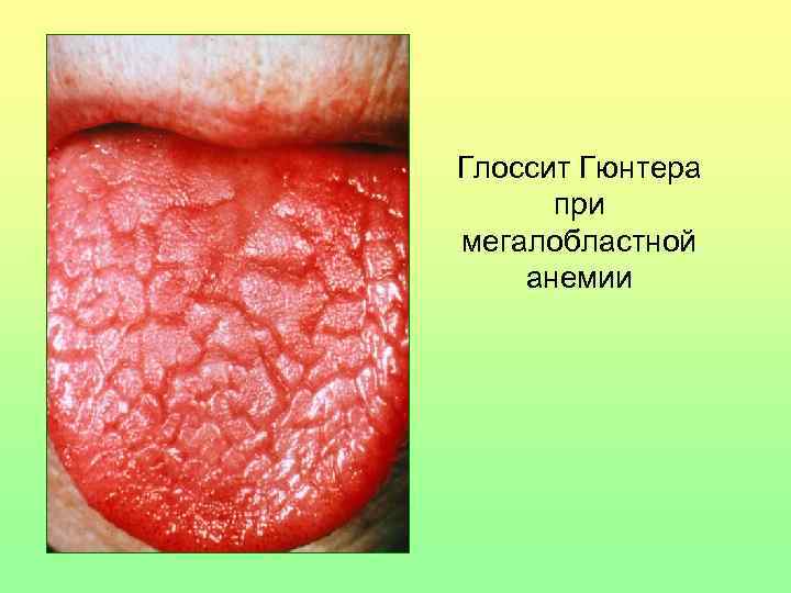 Глоссит Гюнтера при мегалобластной анемии 