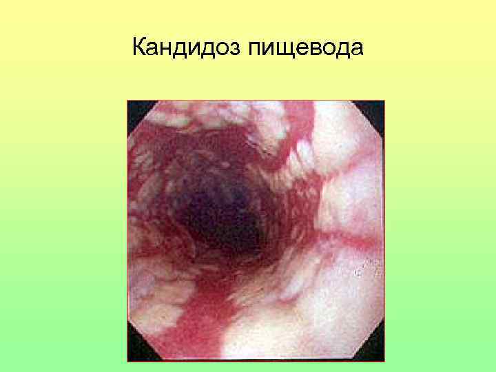 Кандидоз пищевода 