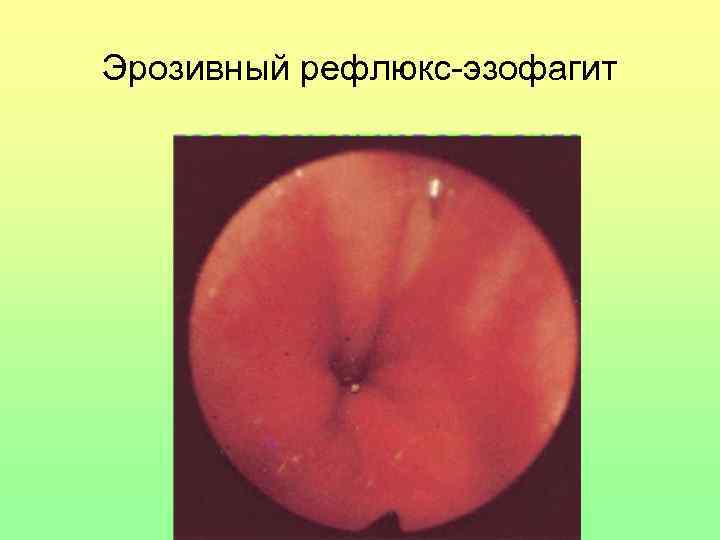 Эрозивный рефлюкс-эзофагит 