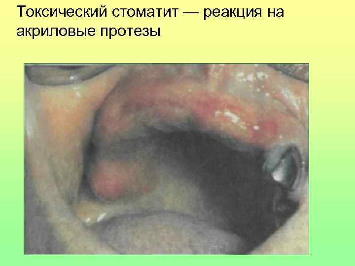 Токсический стоматит — реакция на акриловые протезы 