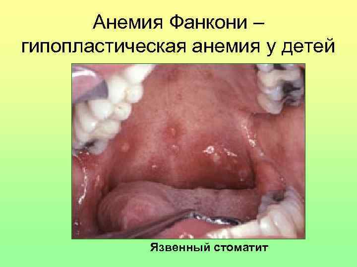Анемия Фанкони – гипопластическая анемия у детей Язвенный стоматит 