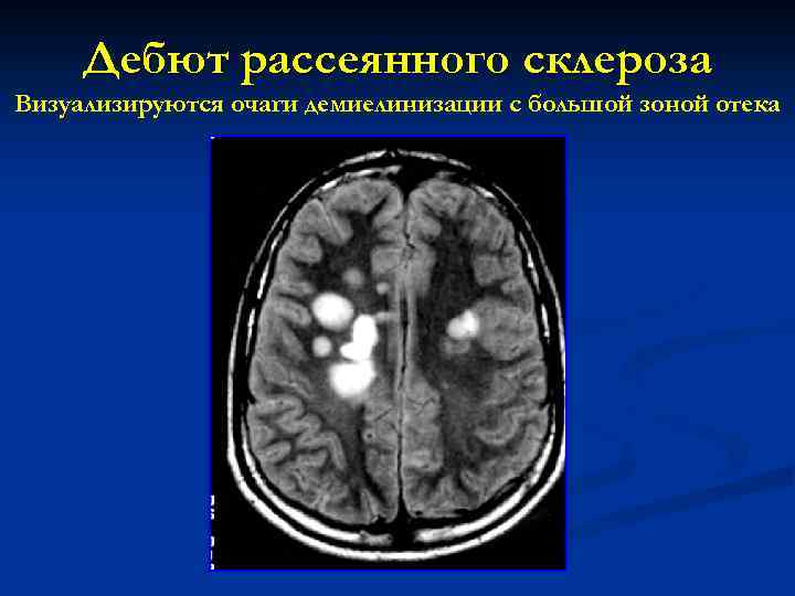 Дебют рассеянного склероза Визуализируются очаги демиелинизации с большой зоной отека 