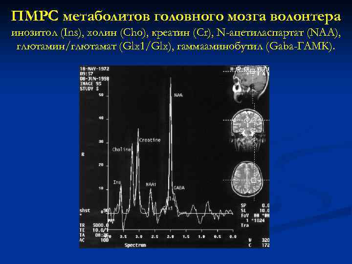 ПМРС метаболитов головного мозга волонтера инозитол (Ins), холин (Cho), креатин (Cr), N-ацетиласпартат (NAA), глютамин/глютамат