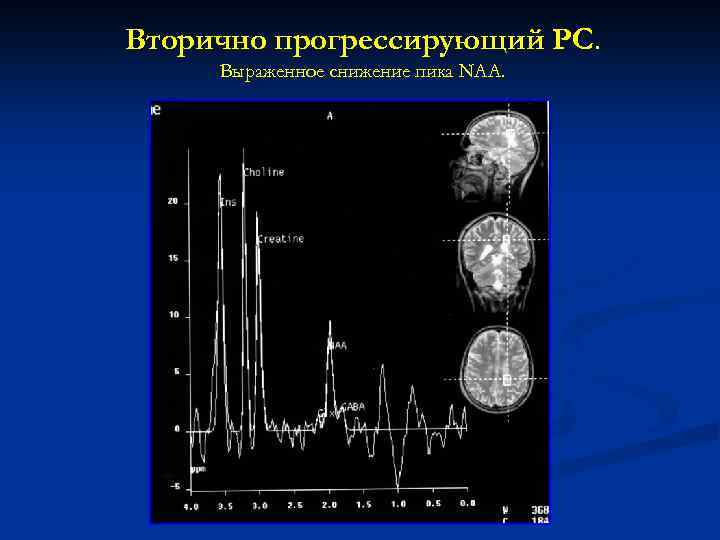 Вторично прогрессирующий РС. Выраженное снижение пика NAA. 