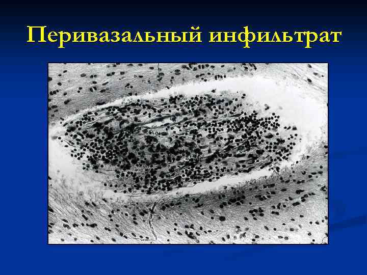 Перивазальный инфильтрат 