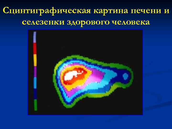 Сцинтиграфическая картина печени и селезенки здорового человека 