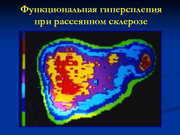 Функциональная гиперспления при рассеянном склерозе 