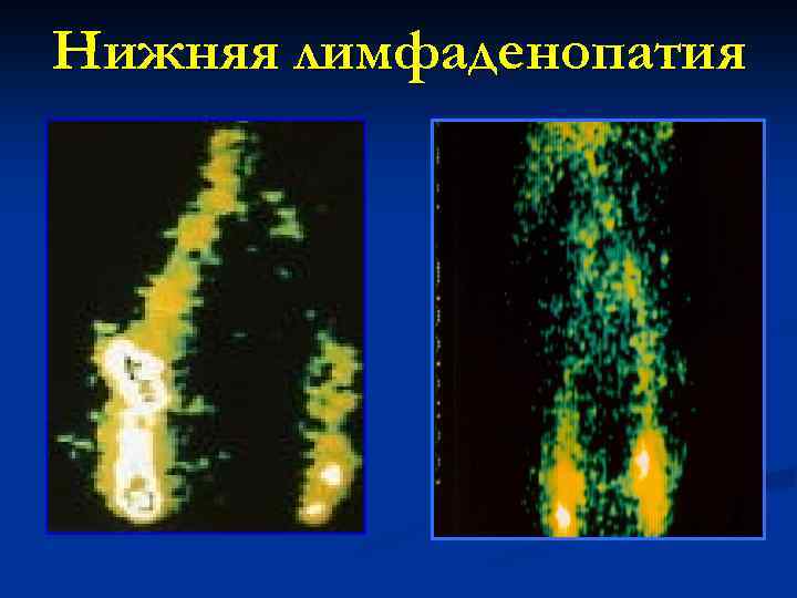 Нижняя лимфаденопатия 