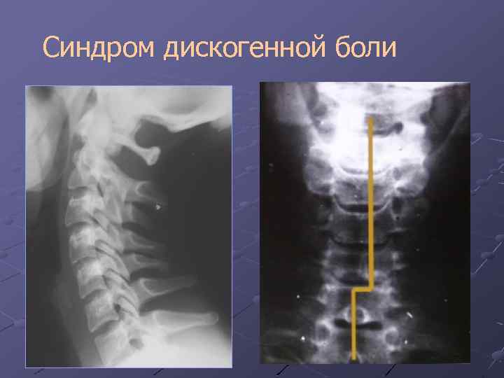 Лучевая диагностика позвоночник презентация