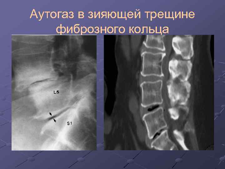 Лучевая диагностика позвоночник презентация