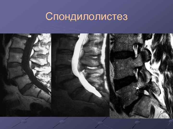 Спондилолистез 