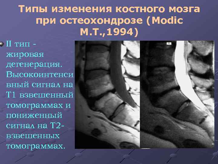 Типы изменения костного мозга при остеохондрозе (Modic M. T. , 1994) II тип жировая