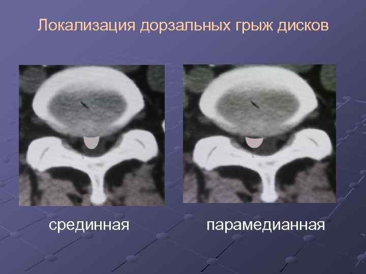 Локализация дорзальных грыж дисков срединная парамедианная 