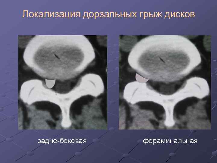 Локализация дорзальных грыж дисков задне-боковая фораминальная 