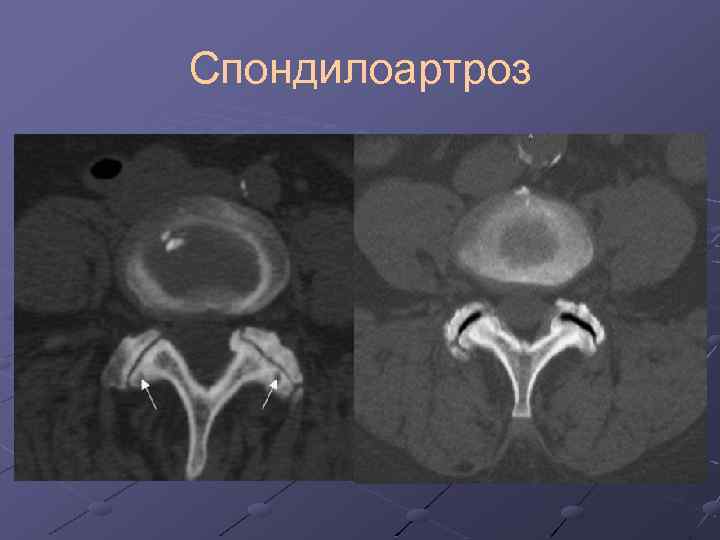 Лучевая диагностика позвоночник презентация