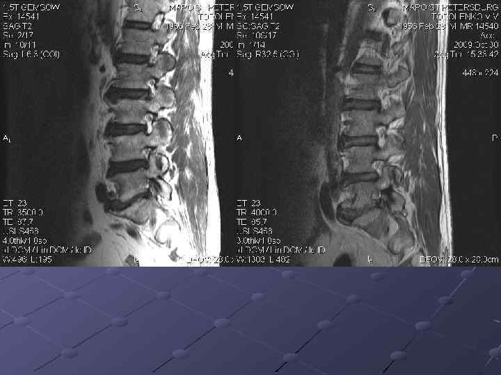 Mp картина дегенеративно дистрофических изменений пояснично крестцового отдела позвоночника