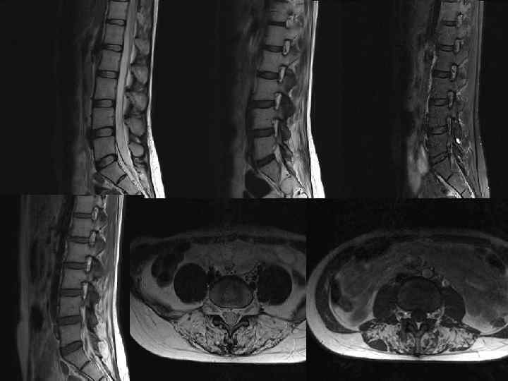 Мр картина дегенеративных изменений поясничного отдела. Фиброзная дисплазия позвоночника мрт. Дистрофические поражения позвоночника. Дегенеративные изменения позвоночника мрт. Рентгенодиагностика заболеваний позвоночника.