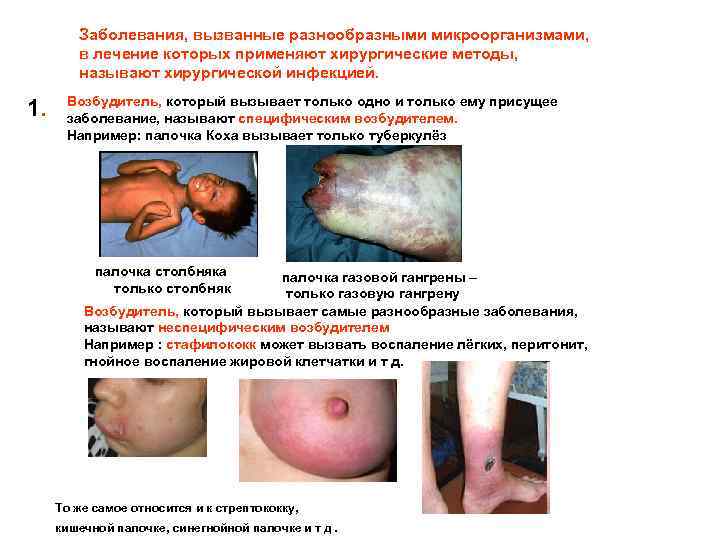 Заболевания, вызванные разнообразными микроорганизмами, в лечение которых применяют хирургические методы, называют хирургической инфекцией. 1.