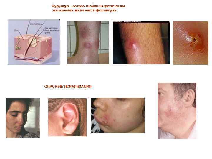 Фурункул – острое гнойно-некротическое воспаление волосяного фолликула ОПАСНЫЕ ЛОКАЛИЗАЦИИ 
