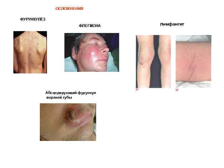 ОСЛОЖНЕНИЯ ФУРУНКУЛЁЗ ФЛЕГМОНА Абсцедирующий фурункул верхней губы лимфангит 
