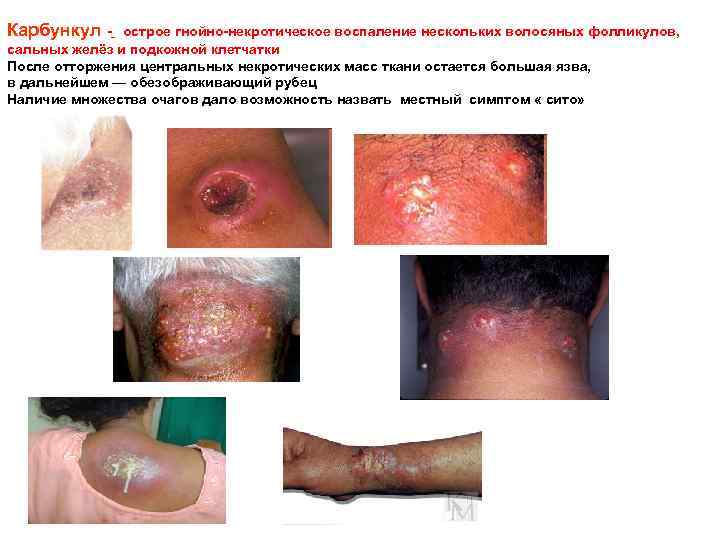 Карбункул - острое гнойно-некротическое воспаление нескольких волосяных фолликулов, сальных желёз и подкожной клетчатки После