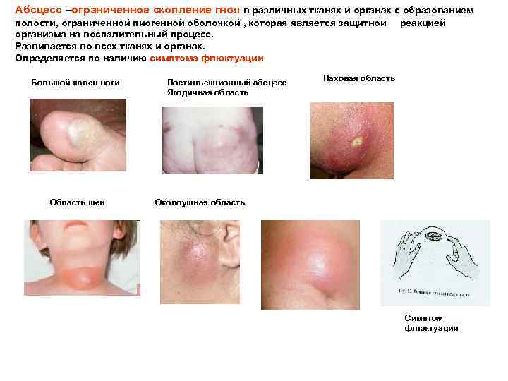 Абсцесс –ограниченное скопление гноя в различных тканях и органах с образованием полости, ограниченной пиогенной