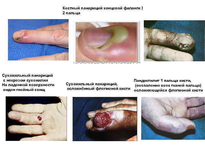 Костный панариций концевой фаланги ) 2 пальца Сухожильный панариций с некрозом сухожилия На ладонной
