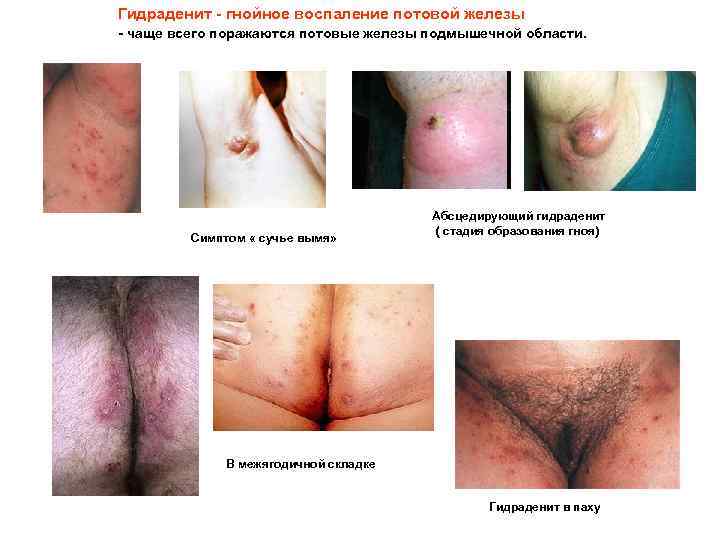 Гидраденит - гнойное воспаление потовой железы - чаще всего поражаются потовые железы подмышечной области.