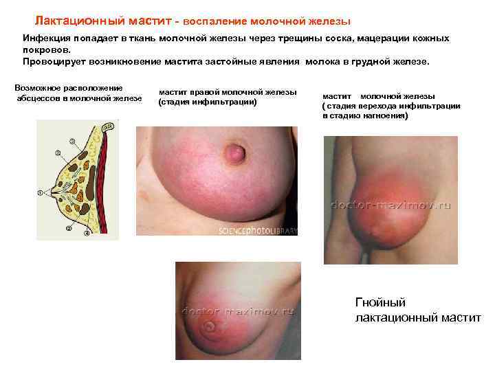 Лактационный мастит - воспаление молочной железы Инфекция попадает в ткань молочной железы через трещины