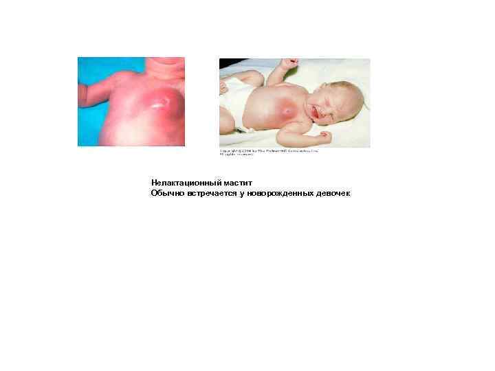 Нелактационный мастит Обычно встречается у новорожденных девочек 
