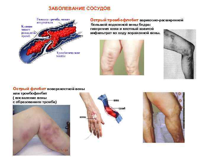 ЗАБОЛЕВАНИЕ СОСУДОВ Острый тромбофлебит варикозно-расширенной большой подкожной вены бедра: гиперемия кожи и плотный извитой
