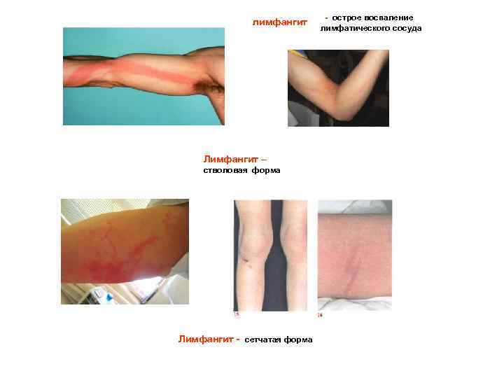 лимфангит Лимфангит – стволовая форма Лимфангит - сетчатая форма - острое воспаление лимфатического сосуда