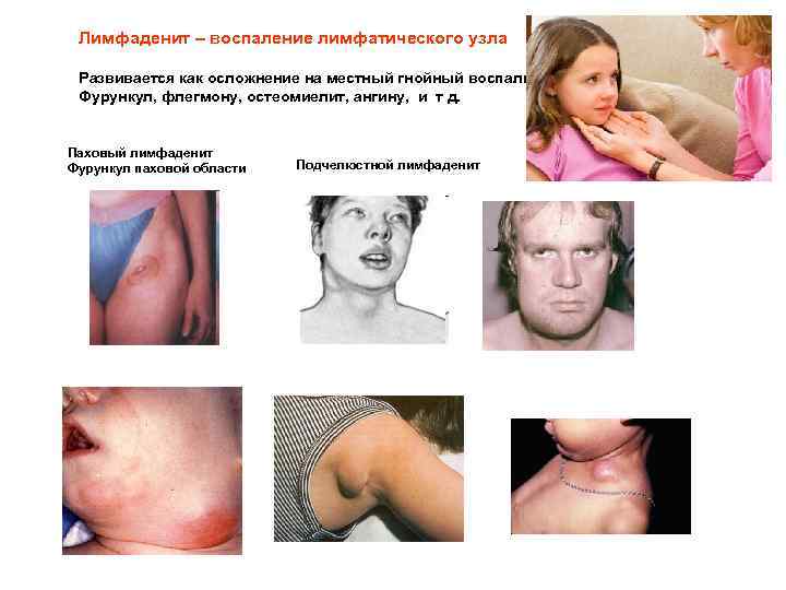 Лимфаденит – воспаление лимфатического узла Развивается как осложнение на местный гнойный воспалительный очаг Фурункул,