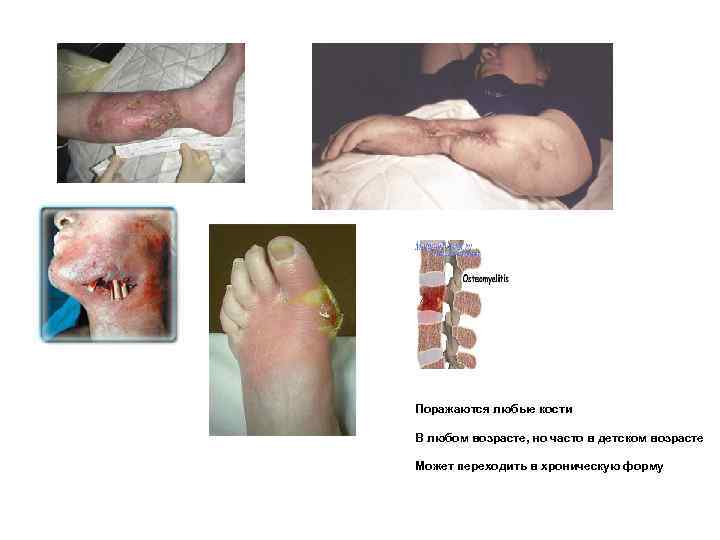 Поражаются любые кости В любом возрасте, но часто в детском возрасте Может переходить в