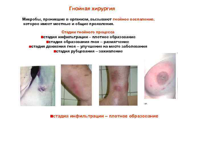 Гнойная хирургия Микробы, проникшие в организм, вызывают гнойное воспаление, которое имеет местные и общие