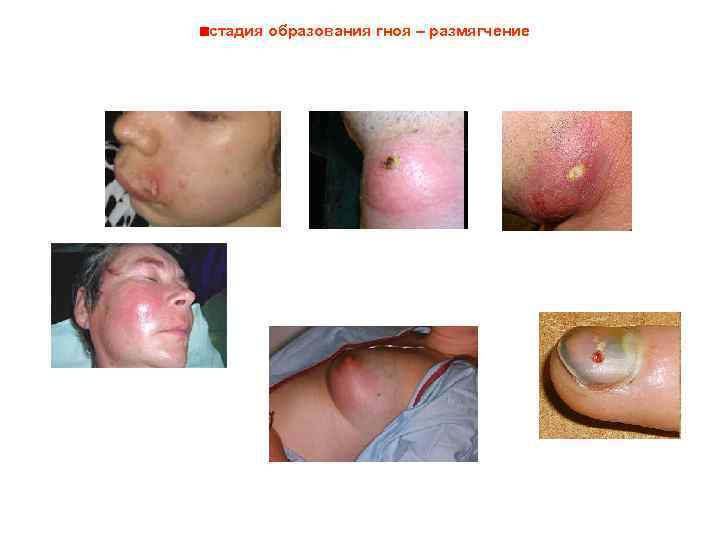 стадия образования гноя – размягчение 