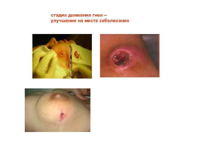 стадия движения гноя – улучшение на месте заболевания 