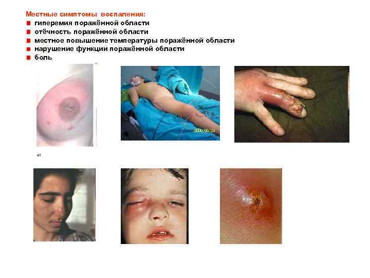 Местные симптомы воспаления: гиперемия поражённой области отёчность поражённой области местное повышение температуры поражённой области