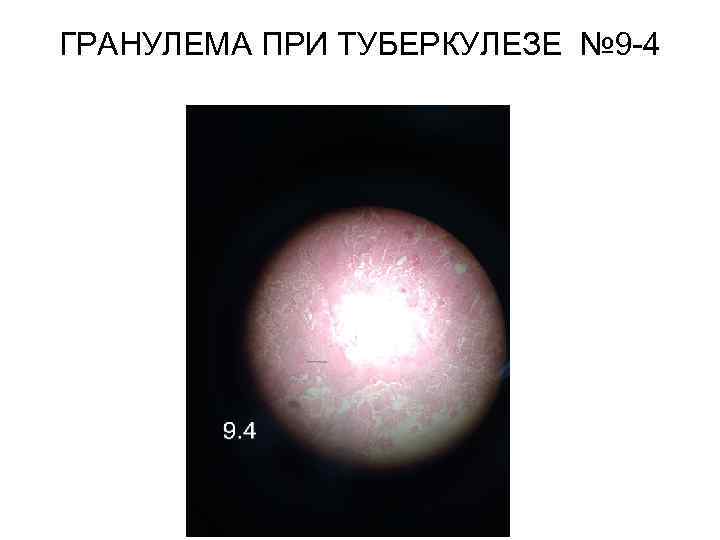 ГРАНУЛЕМА ПРИ ТУБЕРКУЛЕЗЕ № 9 -4 