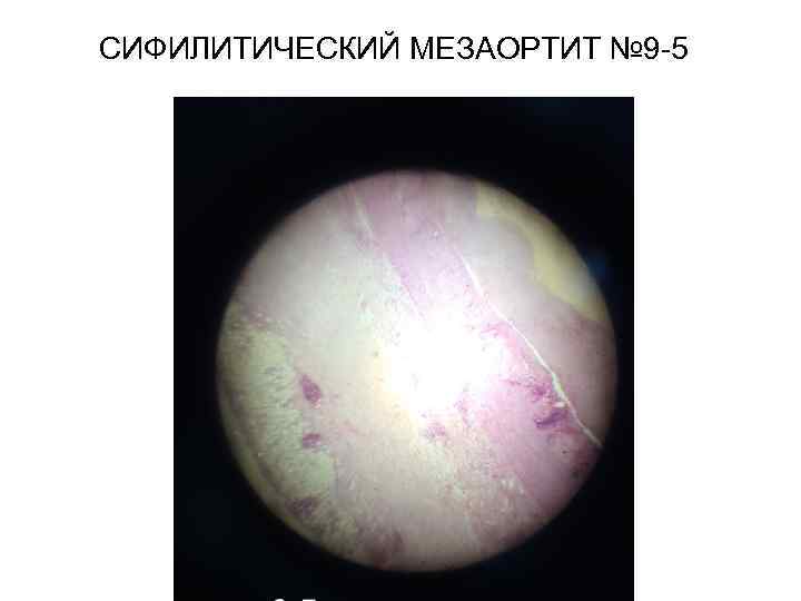 СИФИЛИТИЧЕСКИЙ МЕЗАОРТИТ № 9 -5 